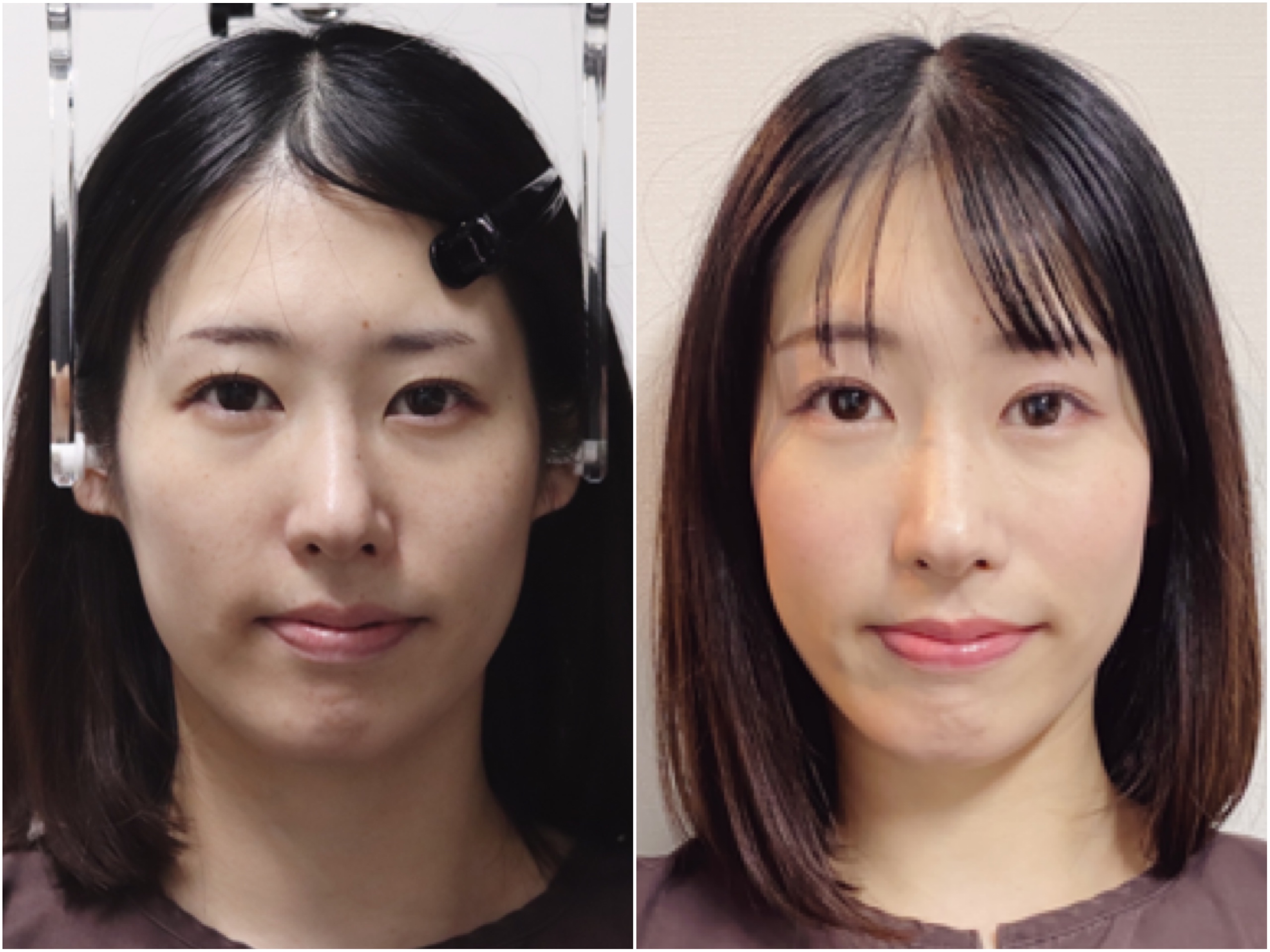 Before/After