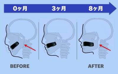 FacialAligners