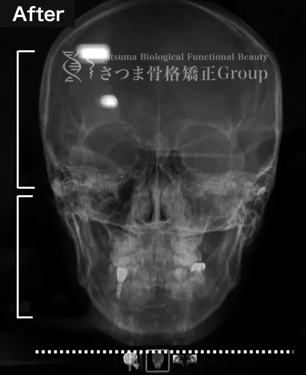 s-xray-before02 s-xray-before02