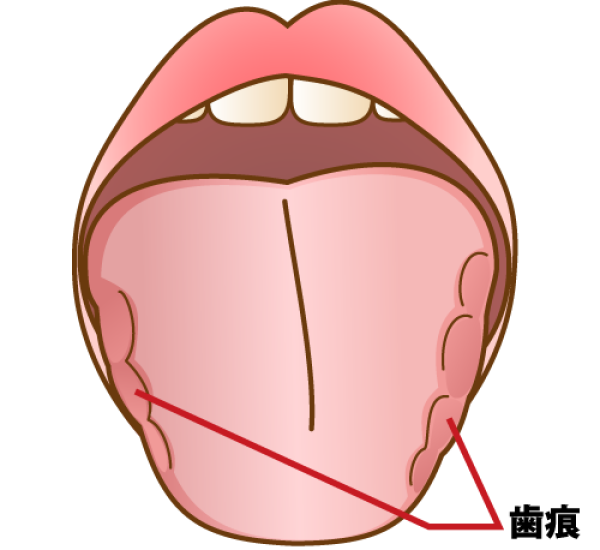 舌圧痕（ぜつあっこん）