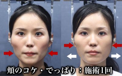 頬のコケ・でっぱり　トップページ